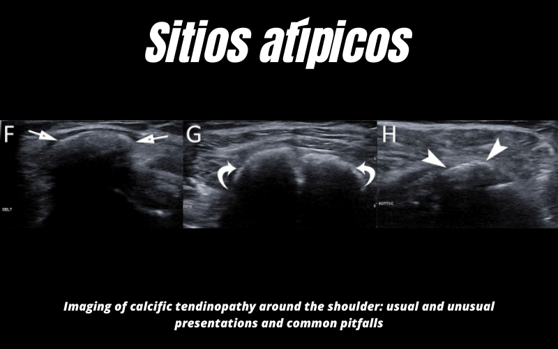 Sitio Atipico Calcificacion Ecografia 11.png